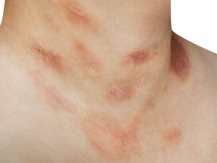 rosacea on upper arms