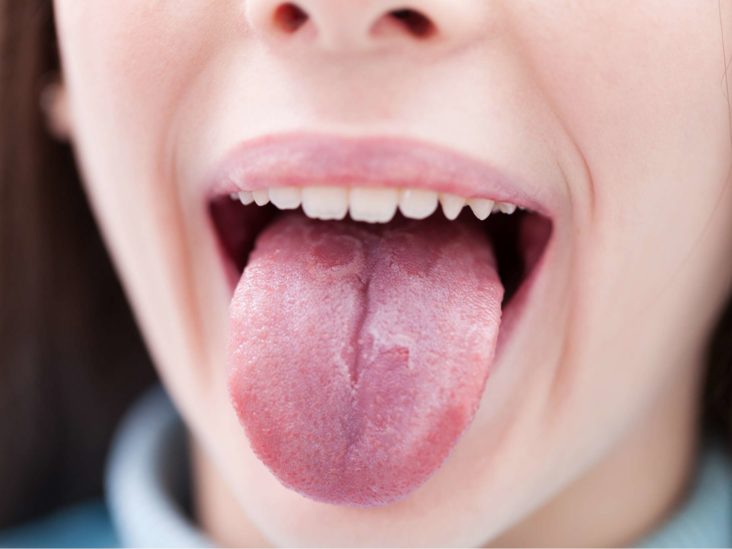 Middle split of tongue in Causes and