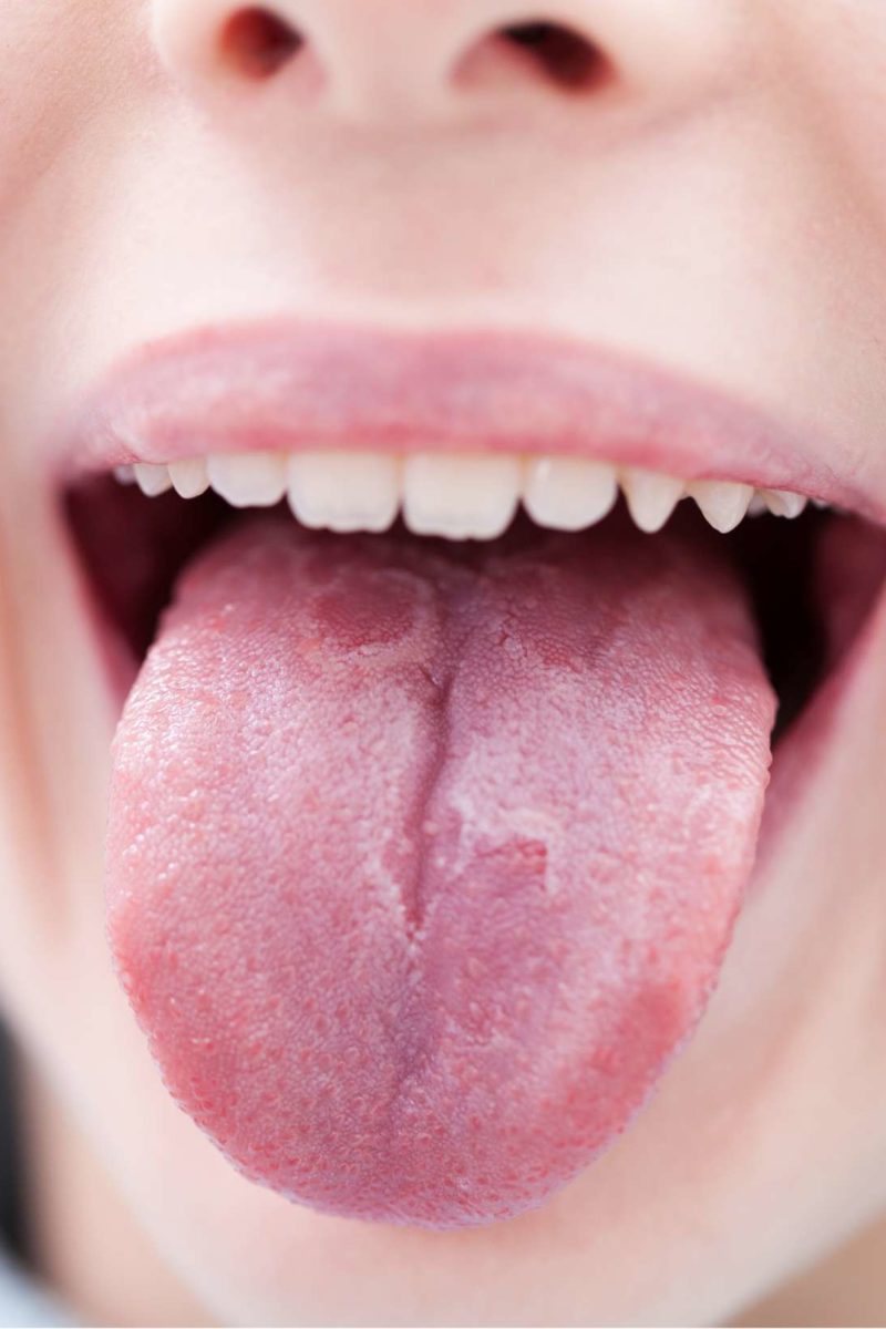 Psoriasis On Tongue