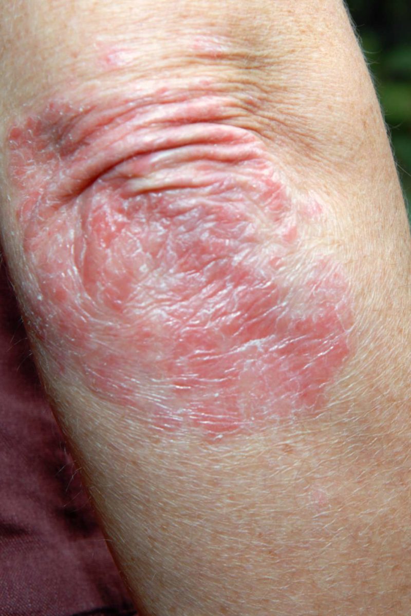 will psoriasis go away on its own