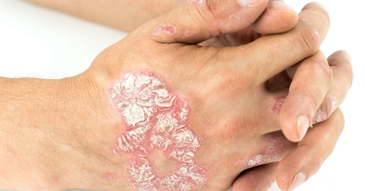 plaque psoriasis how do you get it)