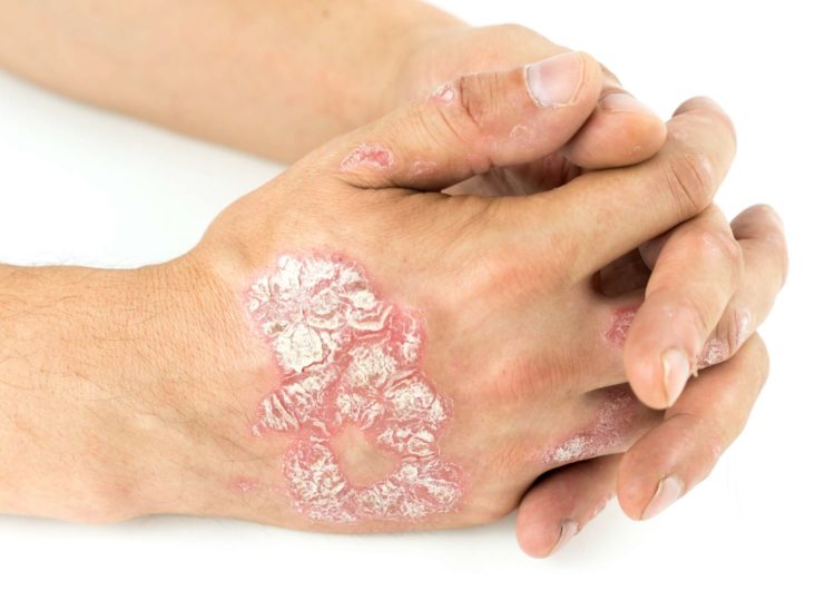 psoriasis scales treatment