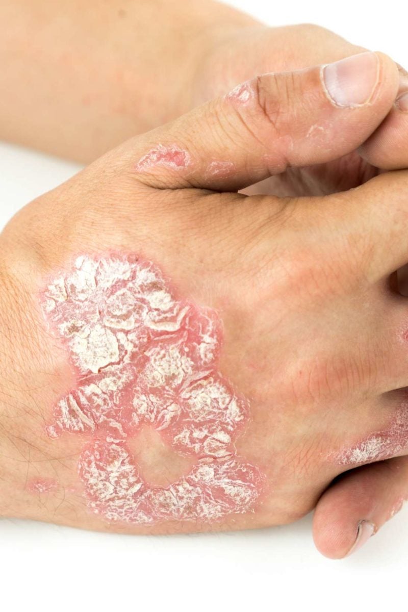 What Is Plaque Psoriasis And What Does It Look Like At Elijah Newton Blog What Is Plaque Psoriasis And What Does It Look Like At Elijah Newton Blog