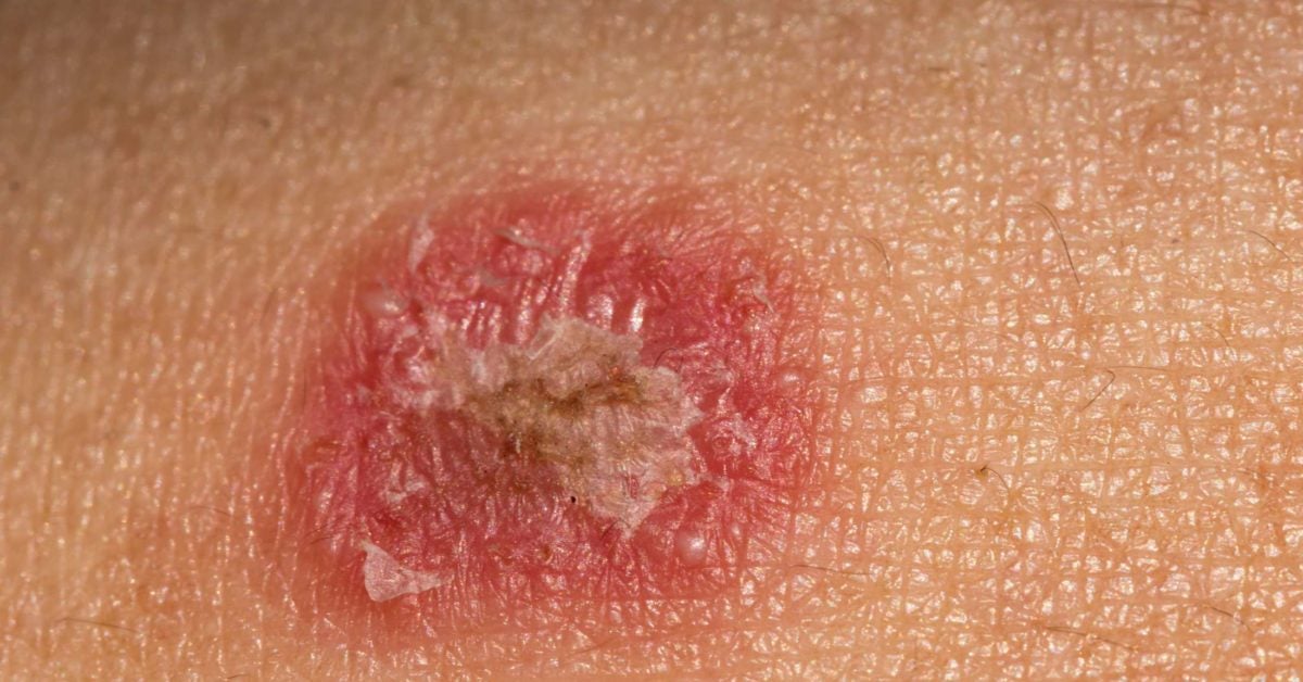 infected psoriasis)