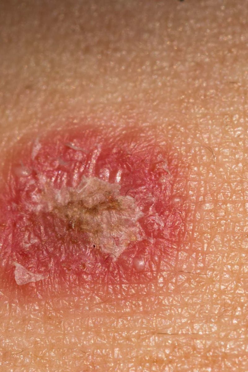 Psoriasis Or Ringworm Symptoms Treatment And Other Rashes