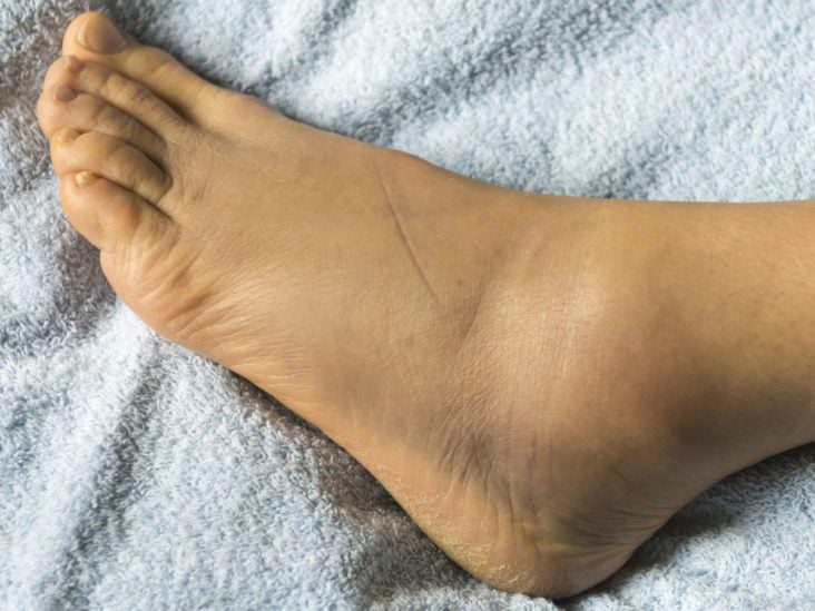 Swollen Feet During Pregnancy Causes And Treatment