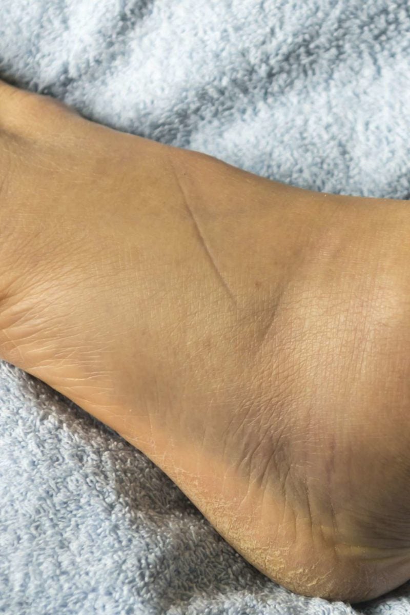 What Medical Conditions Cause Swollen Hands And Feet