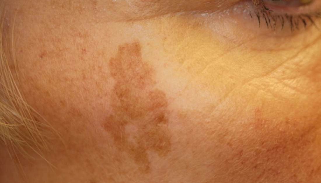 Liver Spots (Solar Lentiginosis)