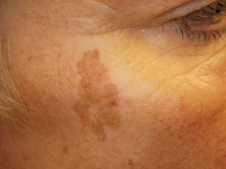 tan marks on face