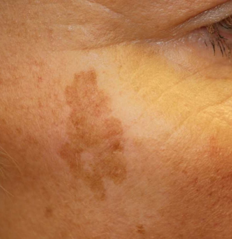 Age spots: Causes, symptoms, and treatment