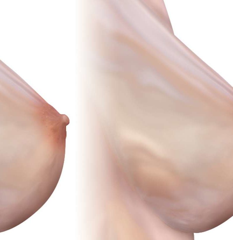 Inverted nipple: Treatment, causes, and pictures