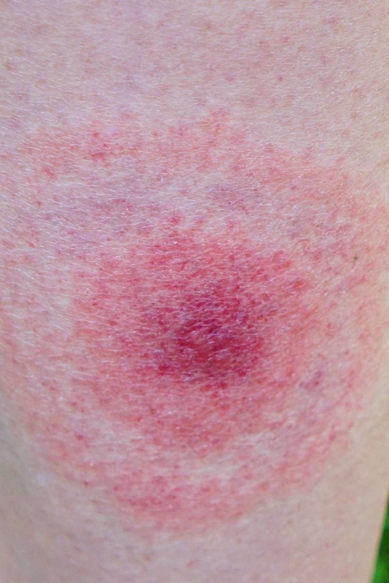 Lyme Disease Tick Bite Rash