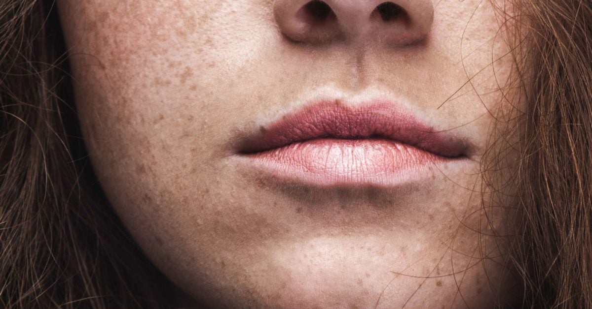 How to remove freckles and moles naturally
