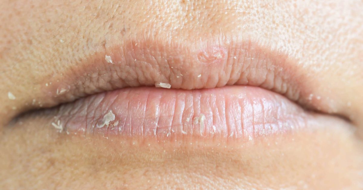 Eczema on the lips: Types, triggers, causes, and treatment