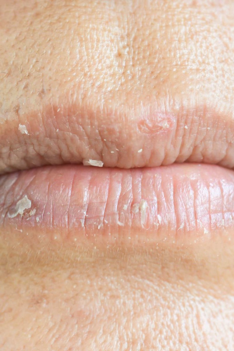 Eczema On The Lips Types Triggers Causes And Treatment