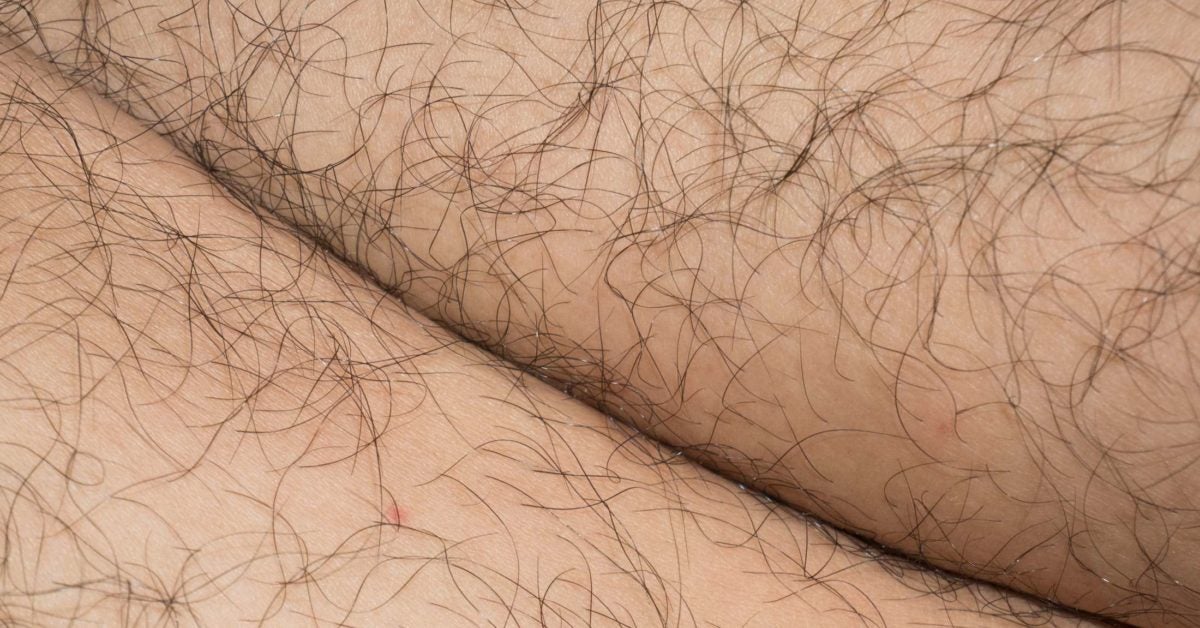 Excessive or unwanted hair in women: Causes and natural treatments