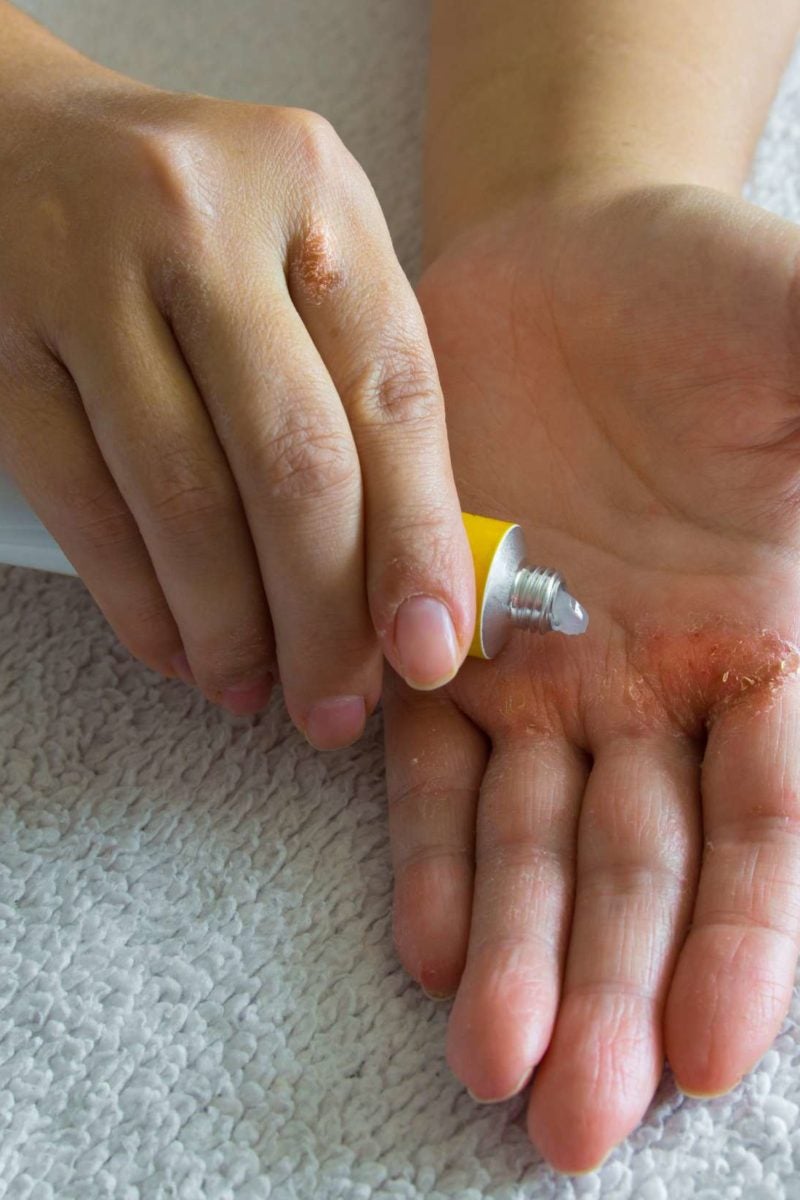 eczema treatment kezelés pikkelysömör frakcióval