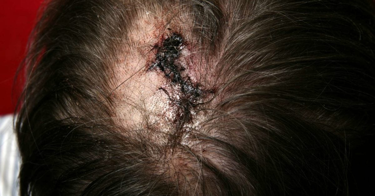 Sores And Scabs On Scalp Pictures Causes And Treatment