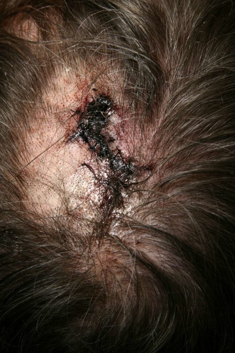 bloody scalp psoriasis