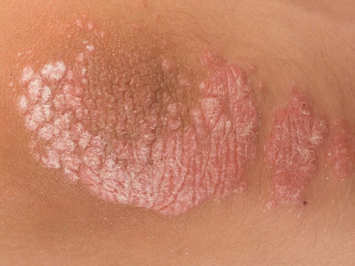 psoriasis stress rash