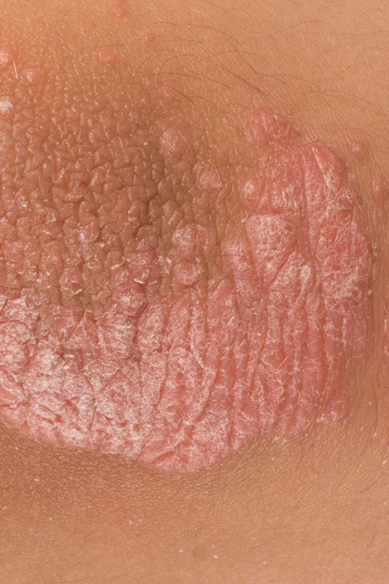 Psoriasis What Are The Signs And Symptoms 