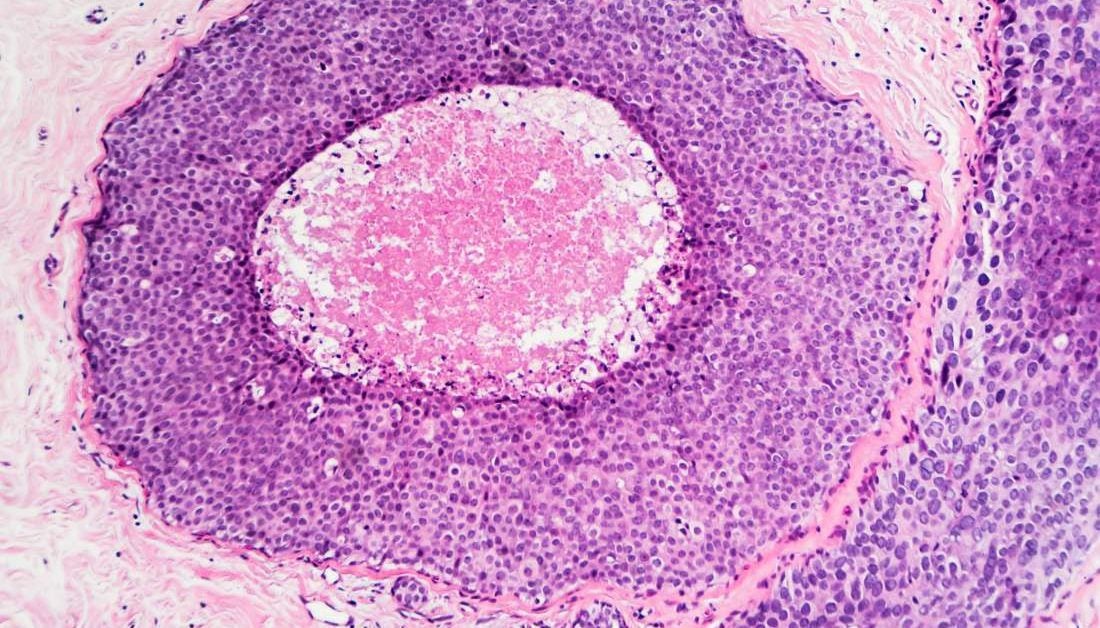 endometrium rákos lenmag