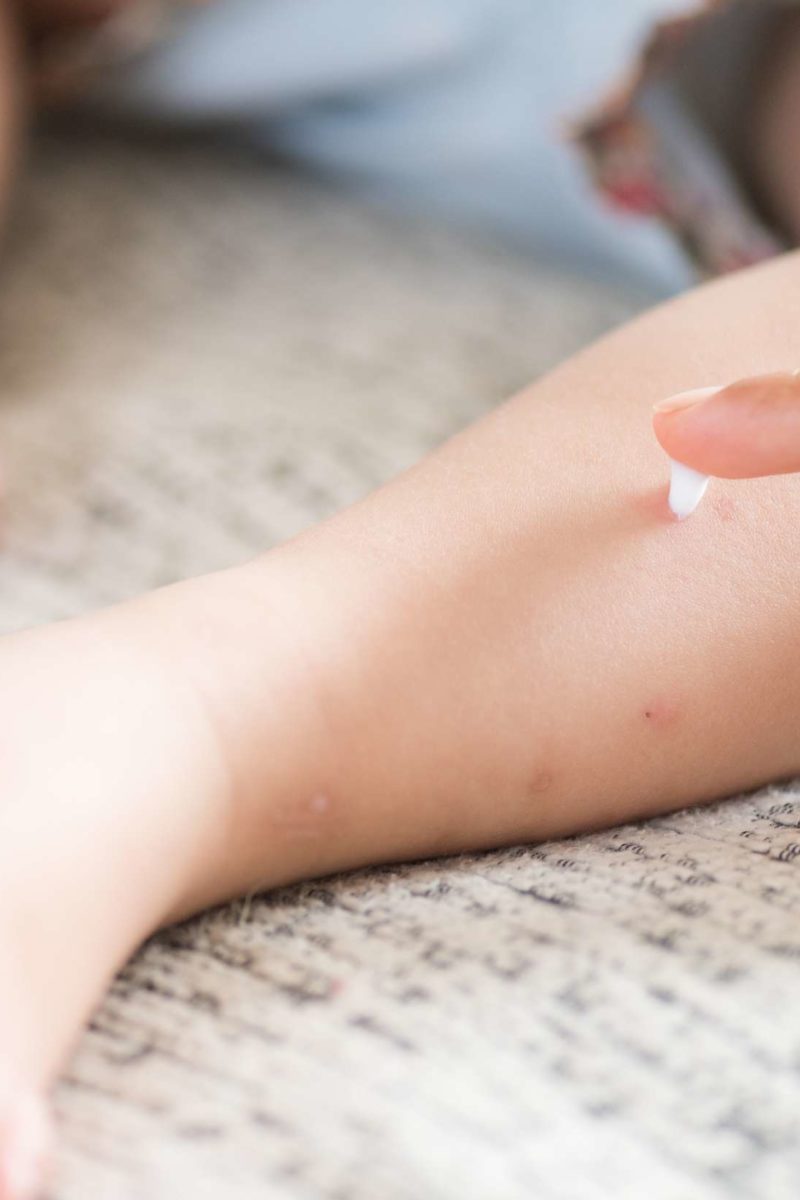 Chickenpox scar removal: Treatments and home remedies