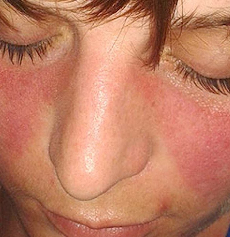 lupus-signs-and-symptoms-with-full-description-of-features