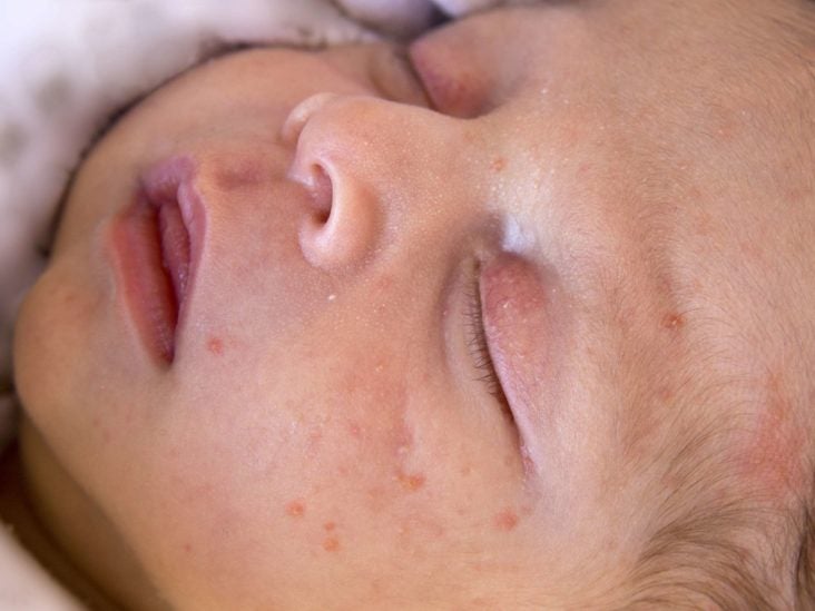 neonatal acne african american