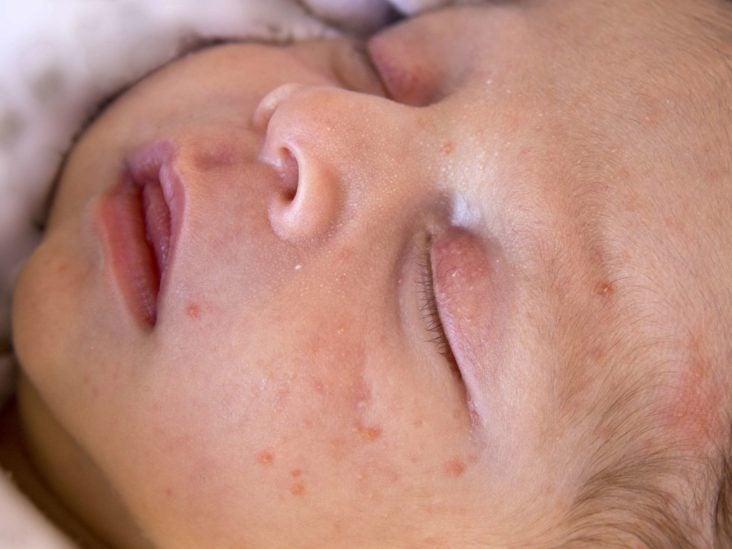 baby acne