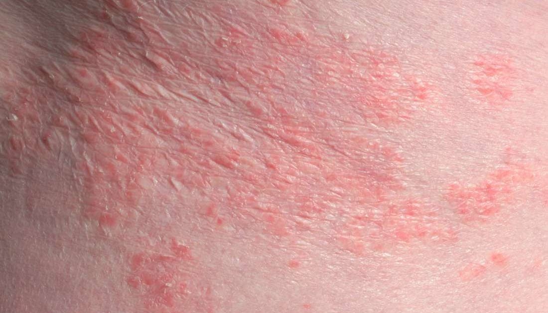 távolítsa el a vörös foltokat a dermatitis után