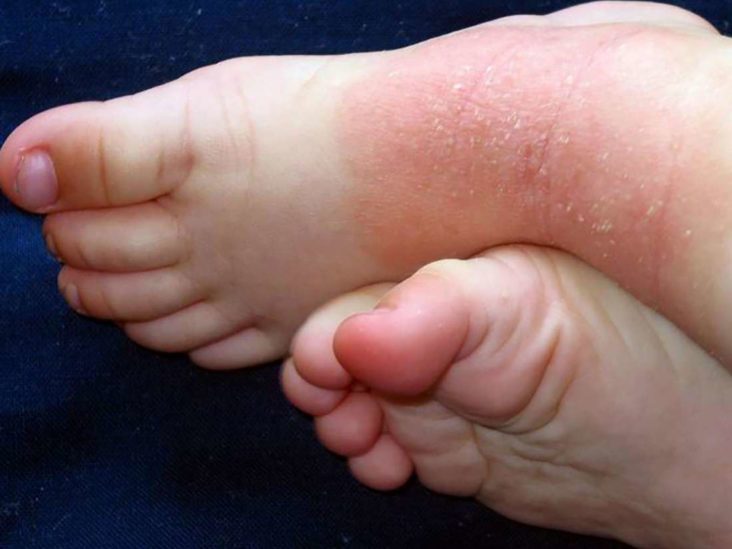 cracked skin under toes child