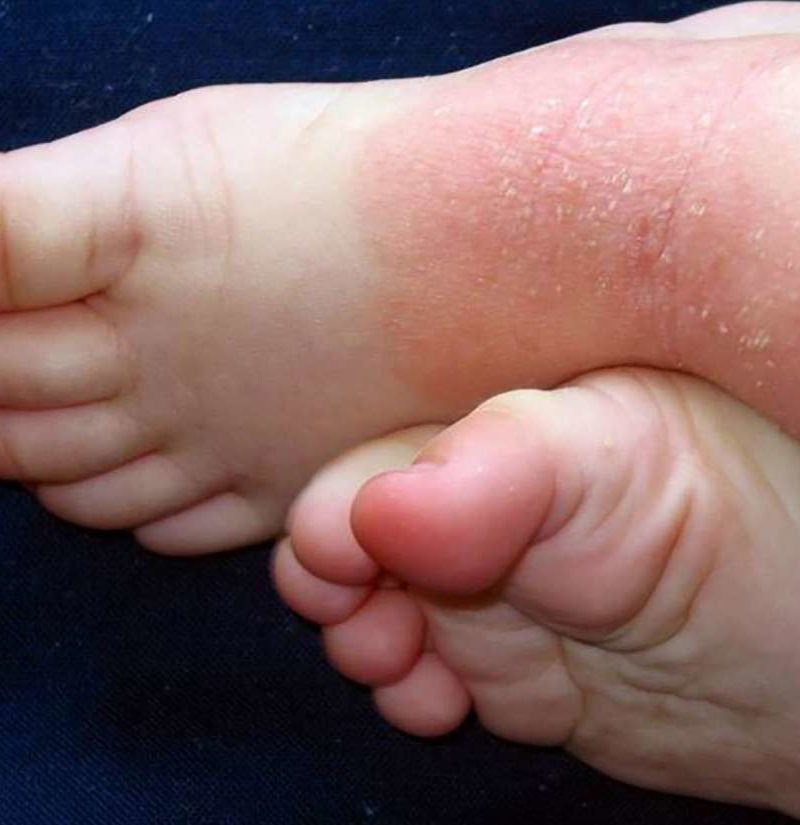 Psoriasis on feet Symptoms, causes, and treatment
