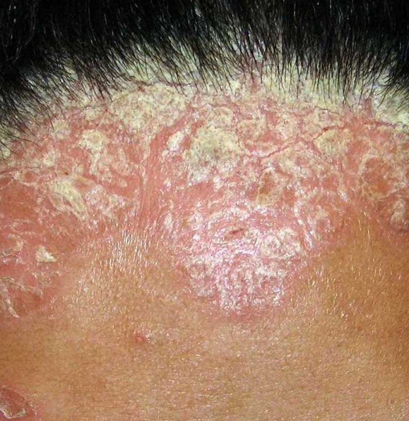 plaque psoriasis symptoms scalp