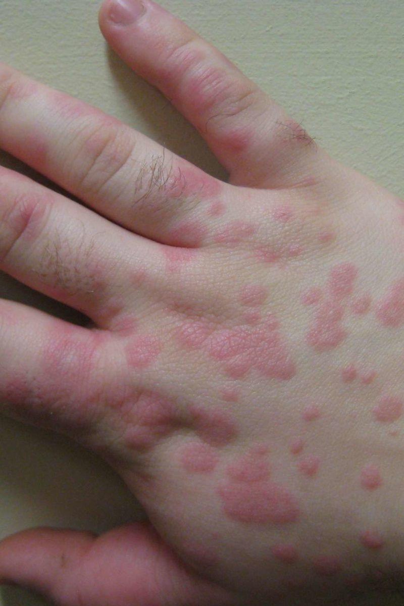 Erythema Multiforme Symptoms Pictures Causes Treatment