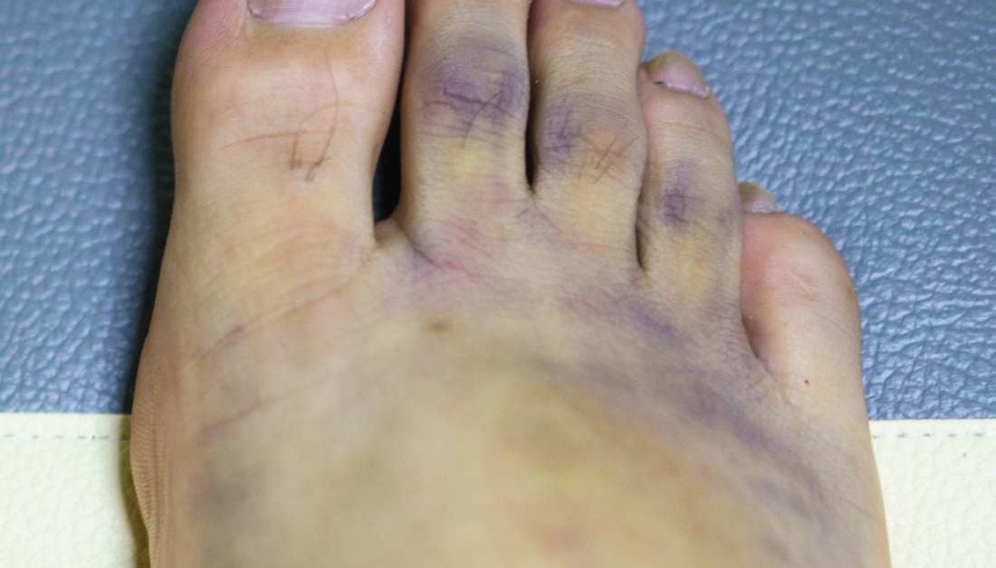 toes diabetic feet purple toe blue covid discoloration symptoms syndrome causes foot treatment coronavirus limbs but