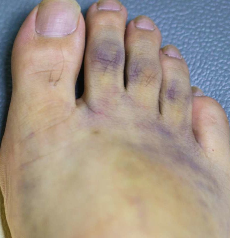 feet purple causes