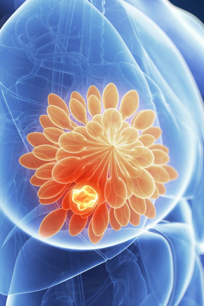 Breast cancer Tumor growth fueled by bone marrow cells