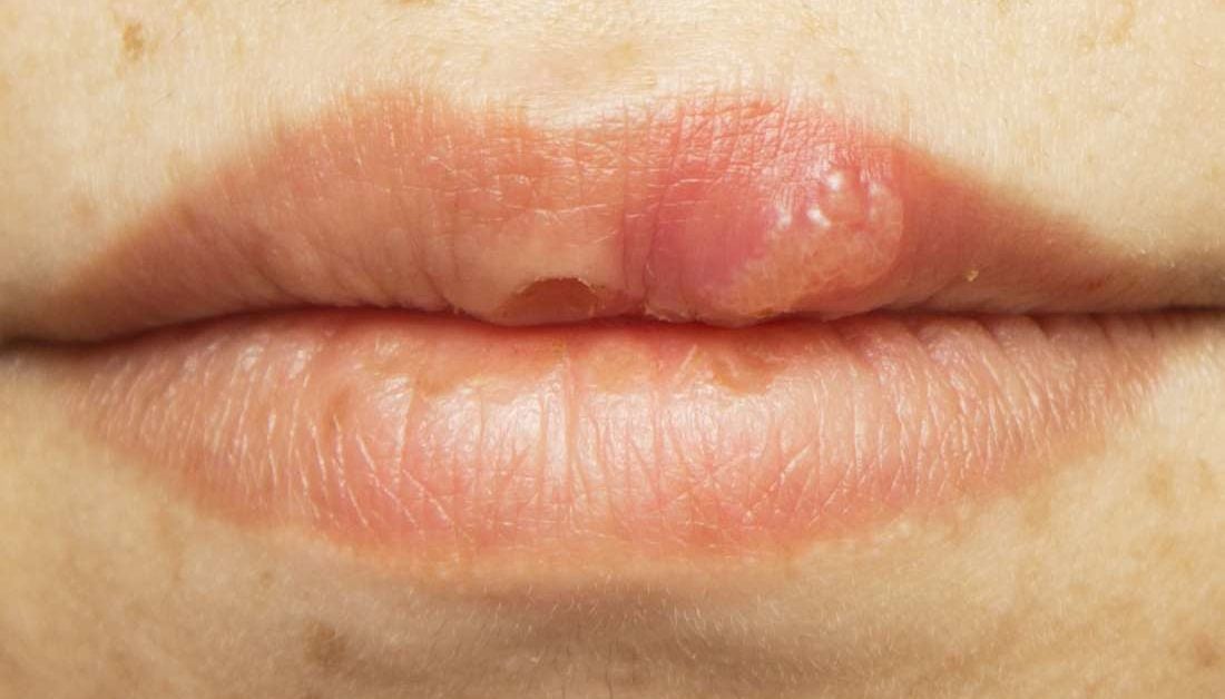 hpv and lip sores cancer epitelial de piel