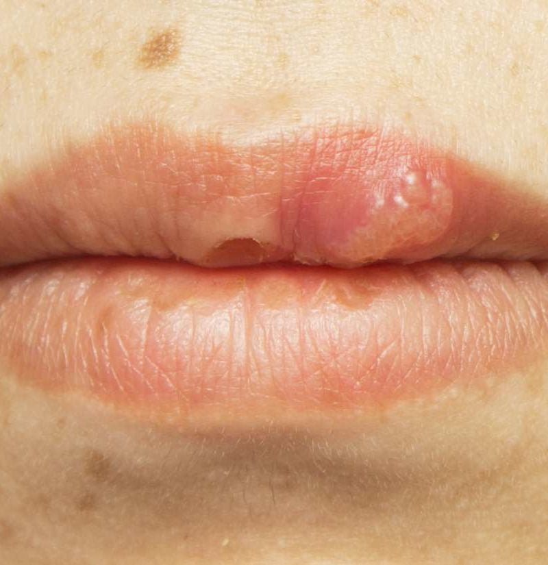 HIV mouth sores: Pictures, causes, treatment, and prevention