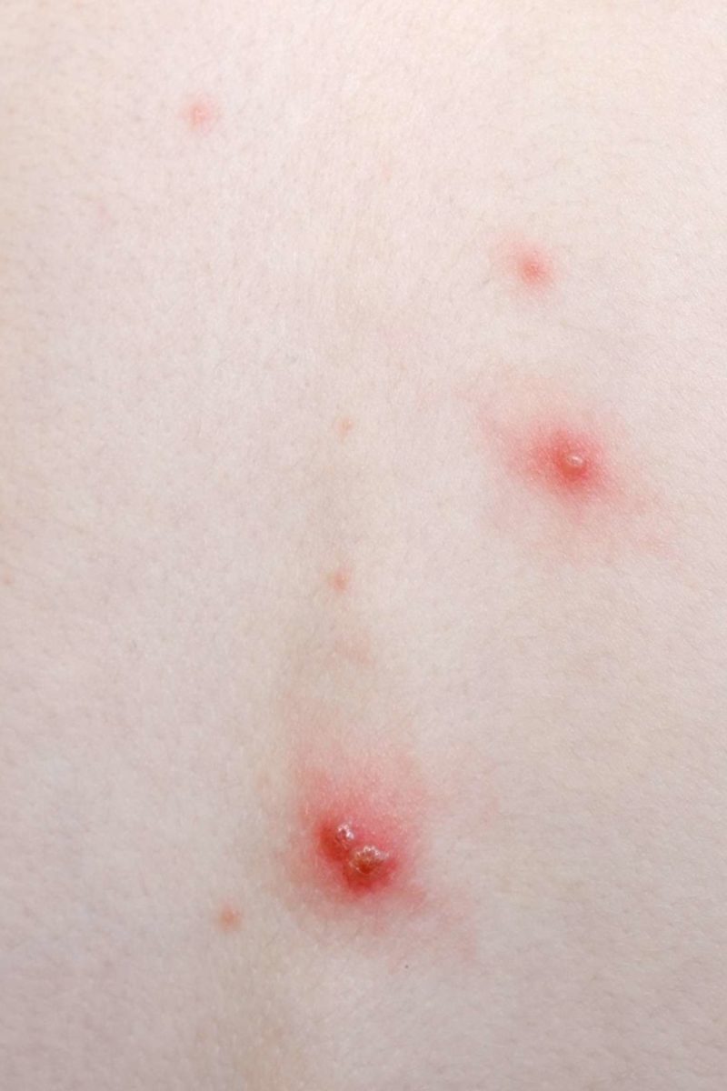 Ce sa faci cu braele varicoase - Prevenire unguent recenzii varicose