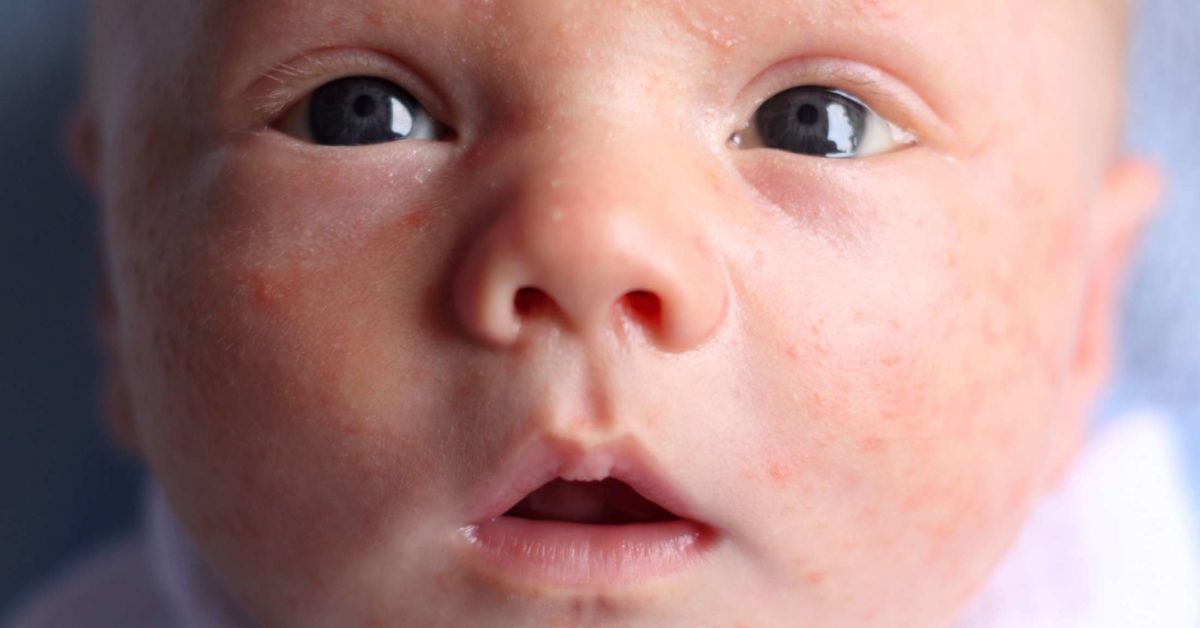 Newborn Rash On Face