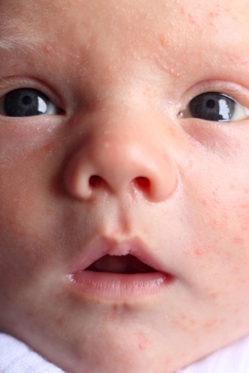 Allergy rash on baby face