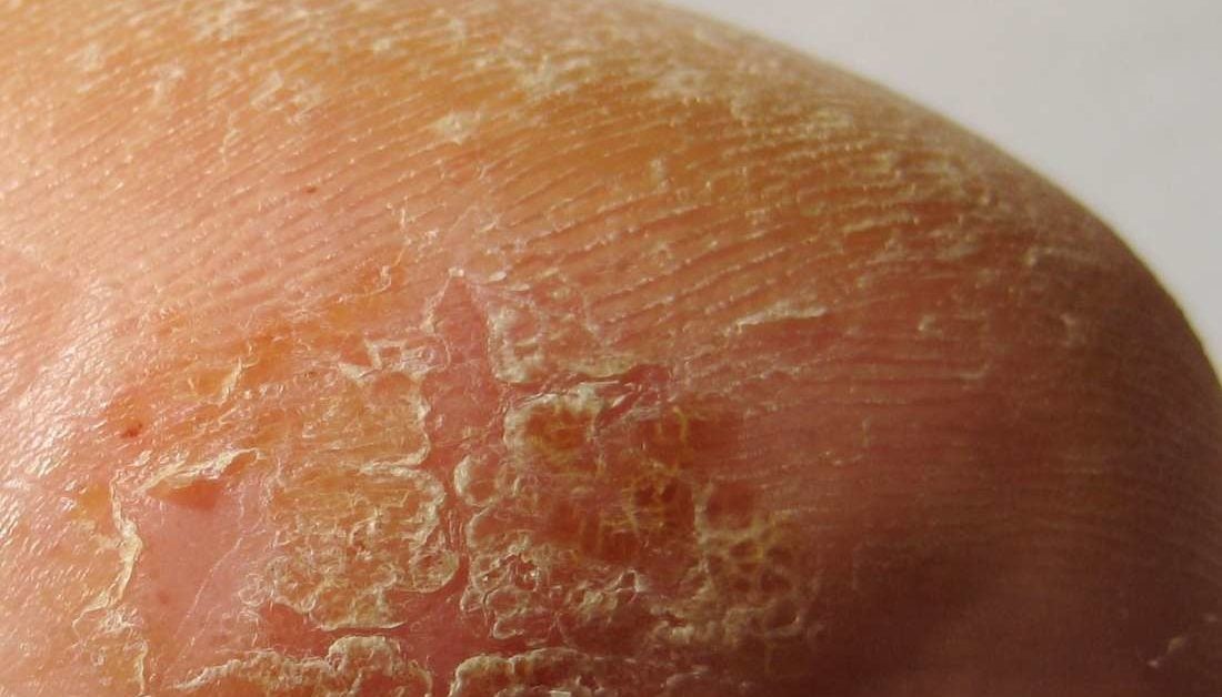 Dry Scaly Rash On Foot