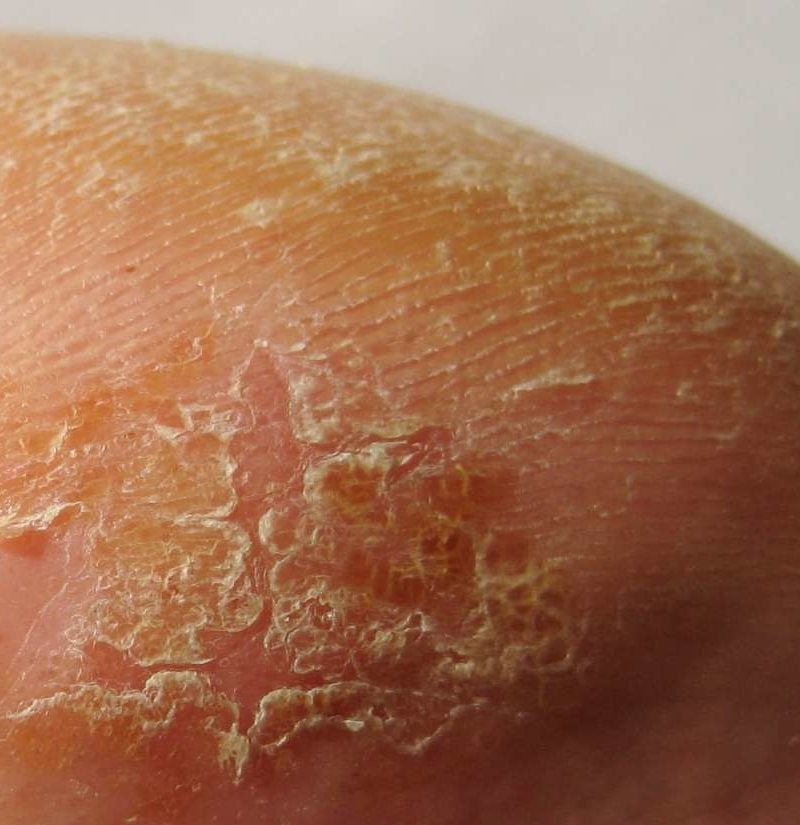 dehydrated skin rash