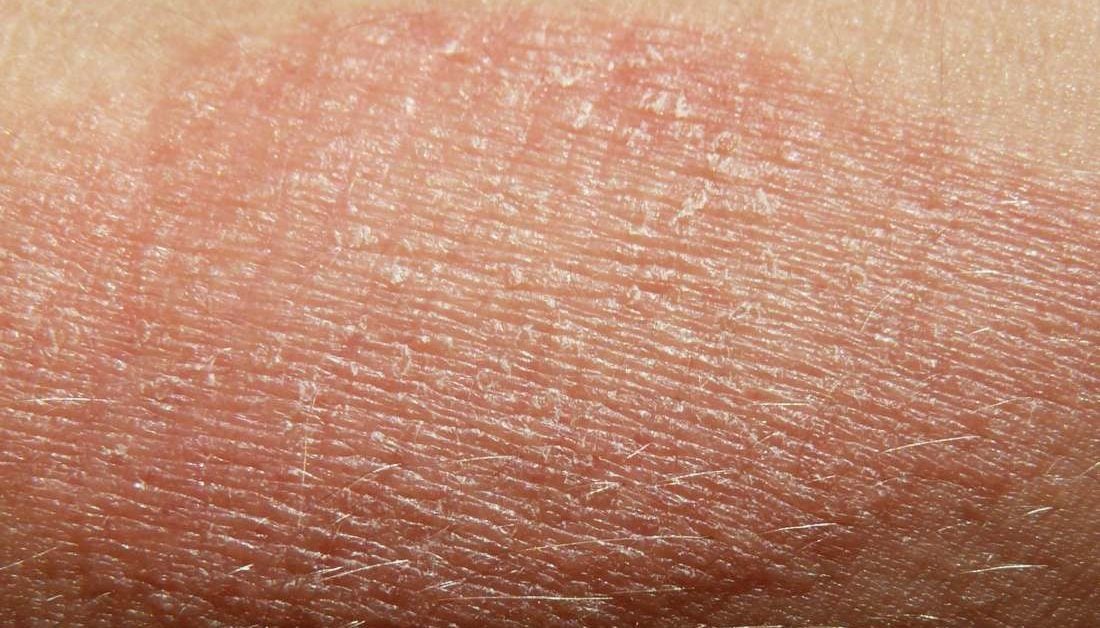 dry peeling skin on face