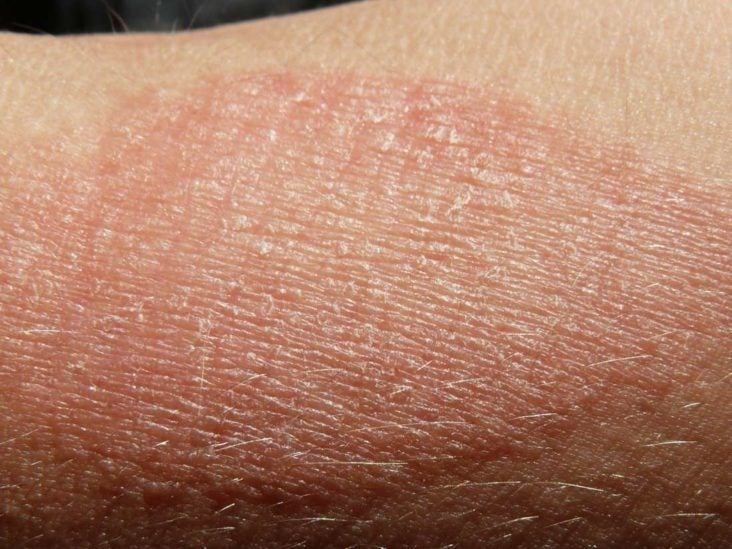 rash that get iritaed from touching it