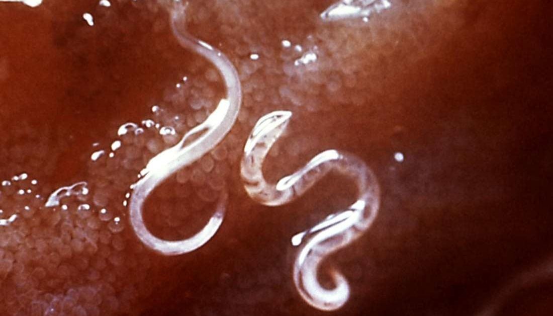 parasites in the human body treatment