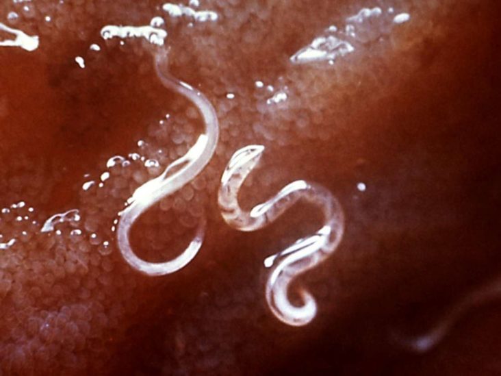Types of human parasite: Worms, infections, and causes