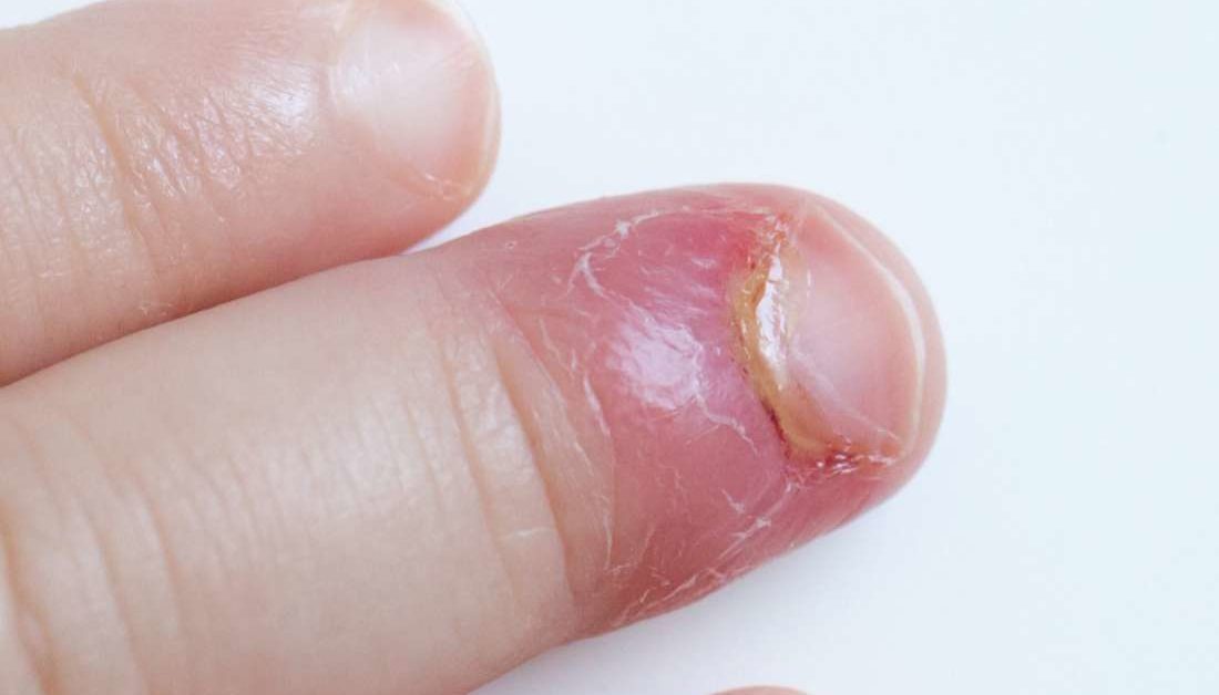 Staph Infection Fingernail